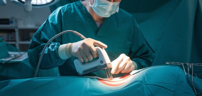 How Defective Surgical Staplers Can Lead to Severe Post-Surgery ...